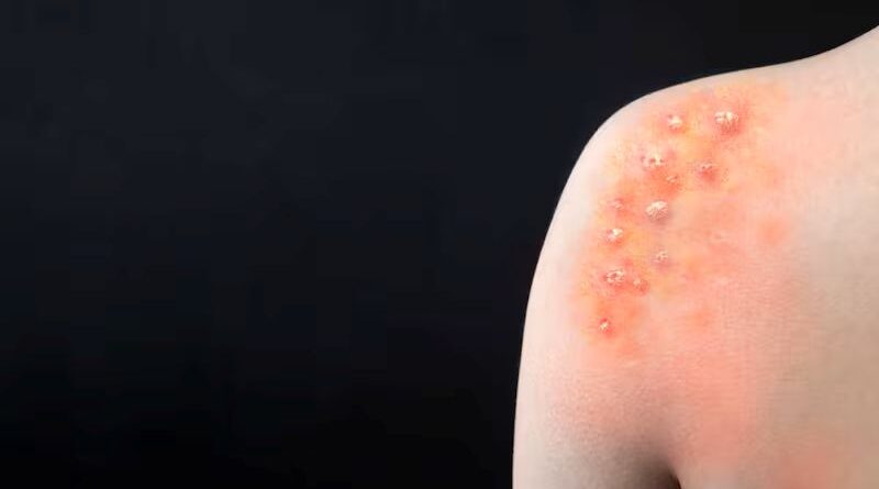 Recomendaciones ante MPOX